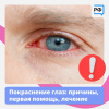 Покраснение глаз Причины, первая помощь, лечение